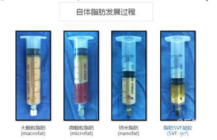 陈滔医生：SVF脂肪baby胶 新技术让脂肪变废为宝