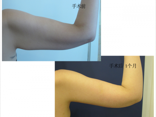 赘皮赘肉怎么去除——韩国首尔slim外科赘皮整形手术！