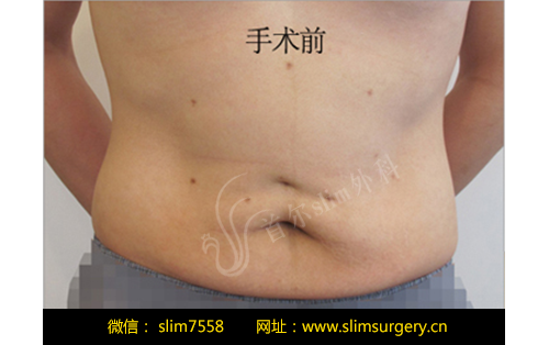 减肥后皮肉松弛严重？韩国首尔slim外科赘皮整形手术了解一下！ ...
