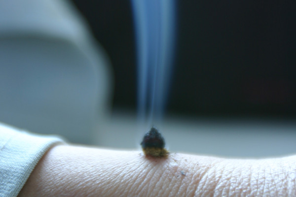 慈利化脓灸：治疗支气管哮喘，展现独特疗效